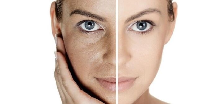 пред и по подмладување на кожата на лицето