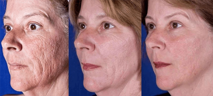 Резултат по ласерска процедура за подмладување на кожата на лицето