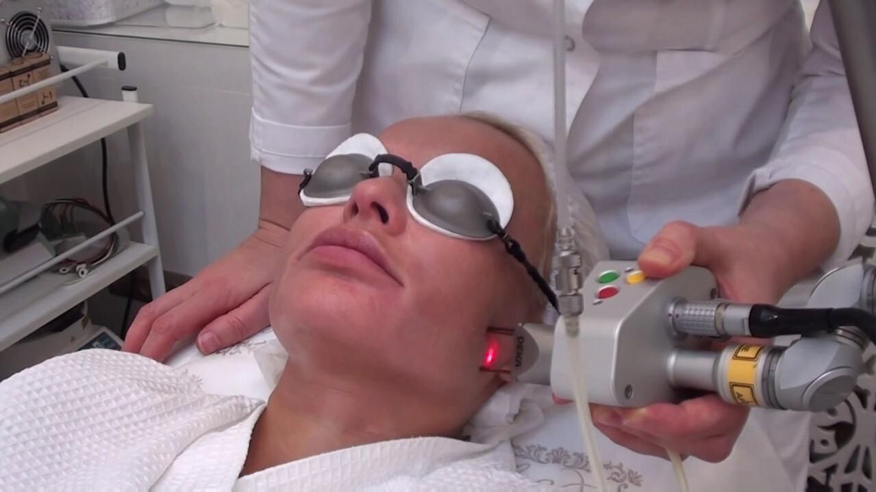 Третман со ласерски зрак на проблематичните области на кожата на лицето