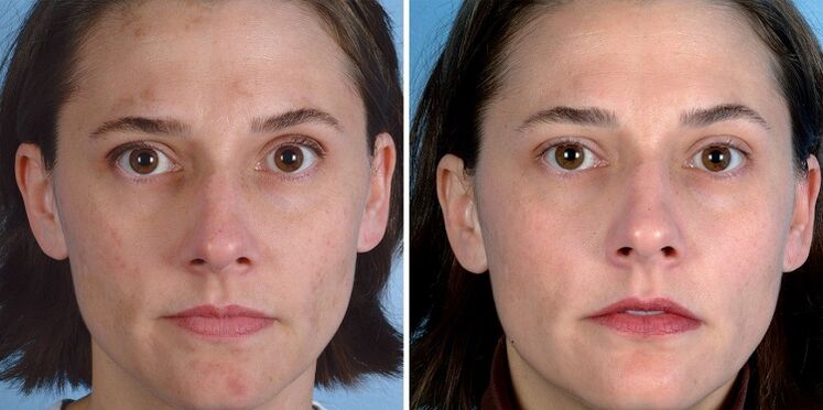 пред и по подмладување на кожата со уредот