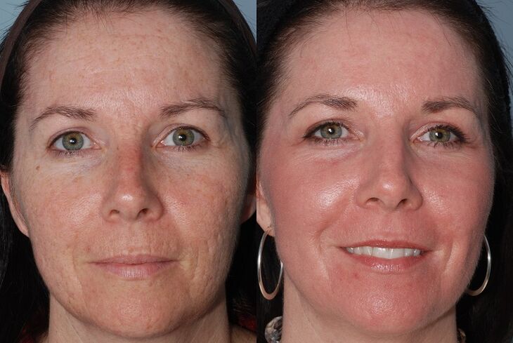 пред и по хардверско подмладување на кожата
