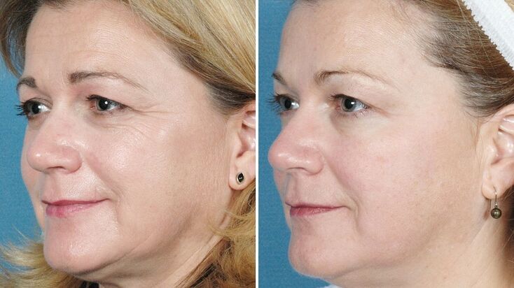 фотографии пред и по хардверско подмладување на кожата