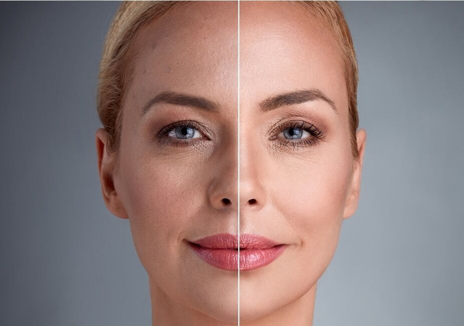 пред и после ласерско подмладување на лицето