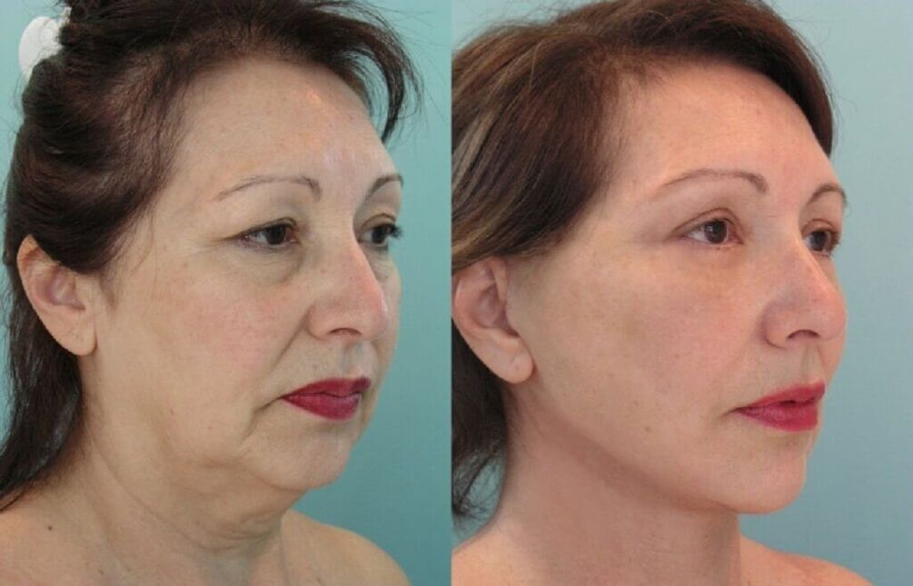 Фотографија пред и по подмладување на кожата