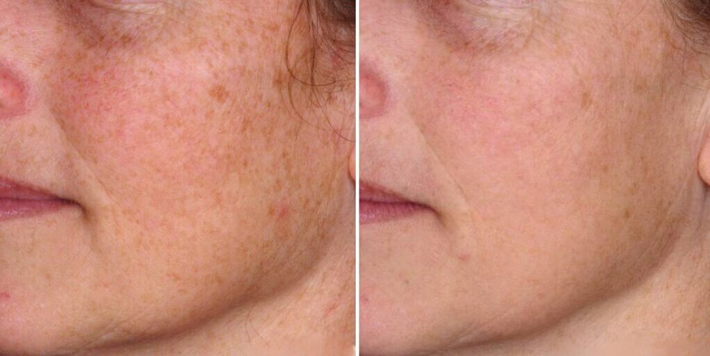 кожата на лицето пред и по подмладување